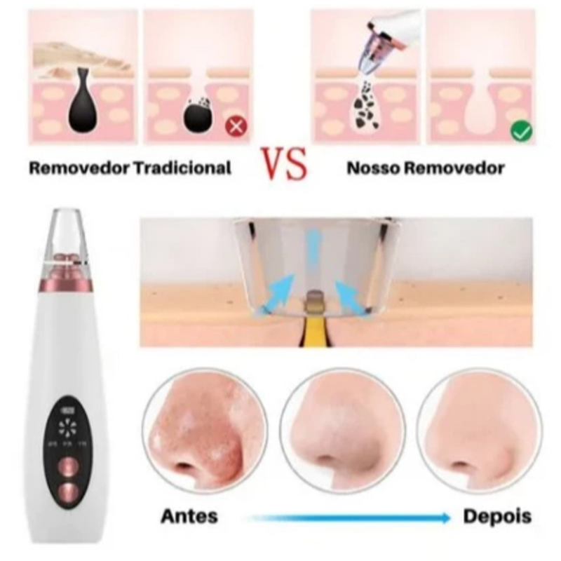 Removedor De Cravos Espinhas Cleaning Sugador Poros Acne Sucção Usb Recarregável